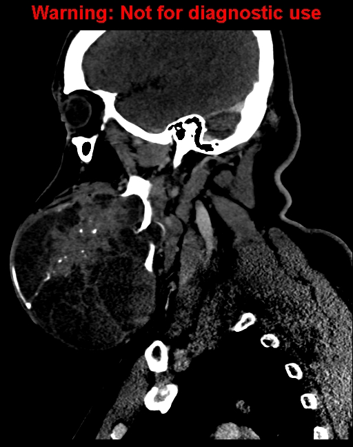 Ameloblastoma (Radiopaedia 33126-34164 F 22).jpg
