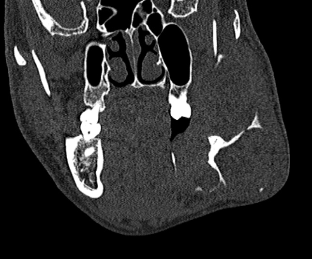 Ameloblastoma (Radiopaedia 51921-57766 Coronal bone window 105).jpg