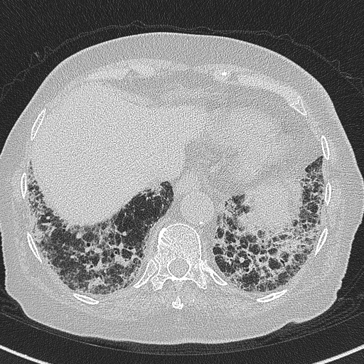 Amiodarone-induced pulmonary fibrosis (Radiopaedia 82355-96460 Axial lung window 56).jpg