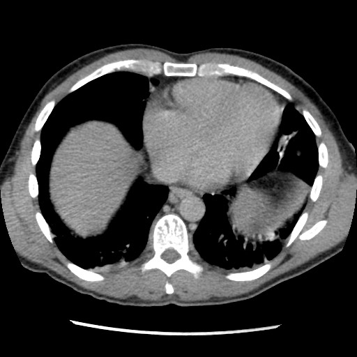 Amoebic liver abscesses (Radiopaedia 55536-62009 Axial C+ delayed 8).jpg