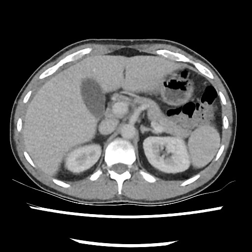 File:Amoebic liver abscesses (Radiopaedia 55536-62010 A 30).jpg