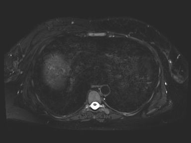 Ampullary adenocarcinoma (Radiopaedia 54765-61014 Axial T2 space-FS 4).jpg