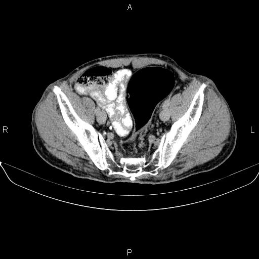 Ampullary adenocarcinoma (Radiopaedia 86093-102032 Axial C+ delayed 87).jpg