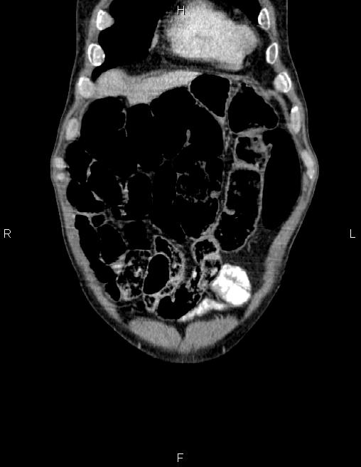 Ampullary adenocarcinoma (Radiopaedia 86093-102032 C 7).jpg