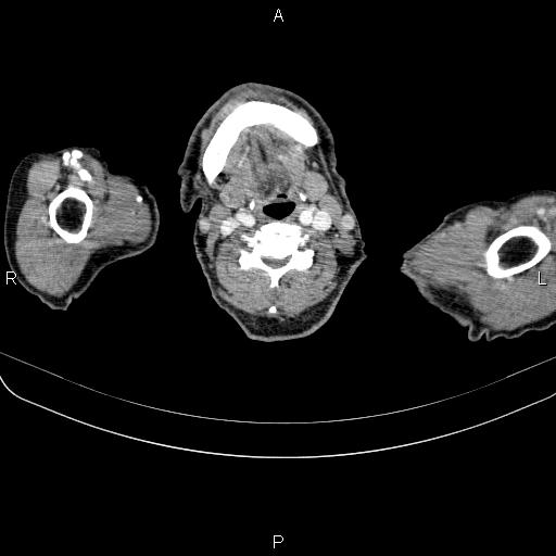 Ampullary adenocarcinoma (Radiopaedia 86093-102033 B 1).jpg