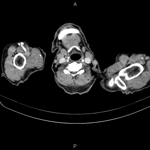Ampullary adenocarcinoma (Radiopaedia 86093-102033 B 3).jpg