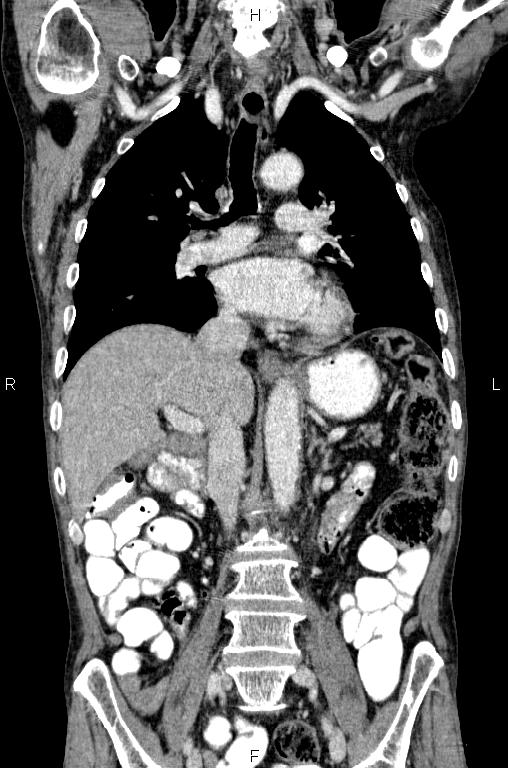 Ampullary adenocarcinoma (Radiopaedia 86093-102033 D 31).jpg