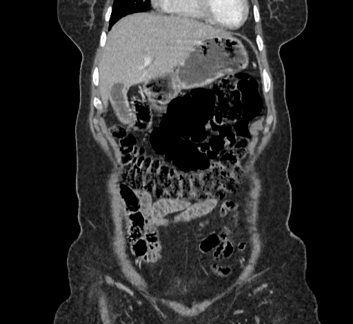 Ampullary tumor (Radiopaedia 60333-67998 B 16).jpg