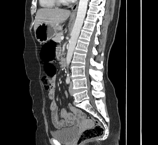 File:Ampullary tumor (Radiopaedia 60333-67998 C 31).jpg