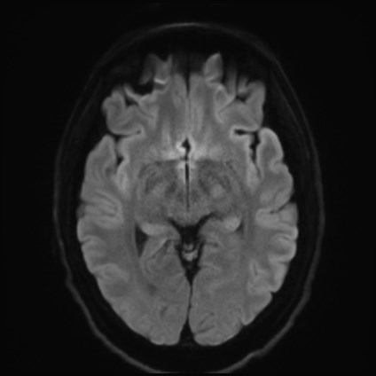 File:Amyotrophic lateral sclerosis (Radiopaedia 87352-103658 Axial DWI 40).jpg