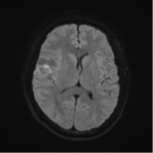 Anaplastic astroblastoma (Radiopaedia 55666-62194 Axial DWI 44).png