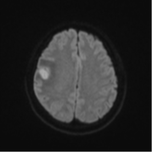 File:Anaplastic astroblastoma (Radiopaedia 55666-62194 Axial DWI 48).png