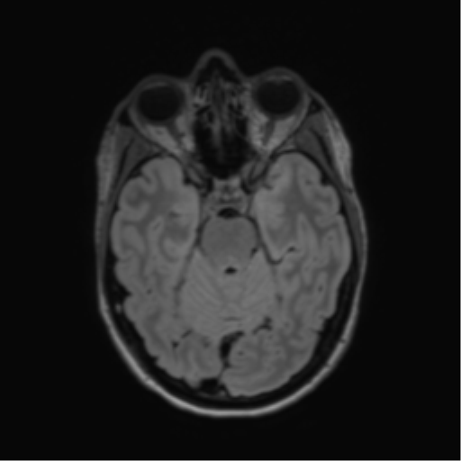 File:Anaplastic astrocytoma IDH mutant (Radiopaedia 50046-55341 Axial FLAIR 18).png
