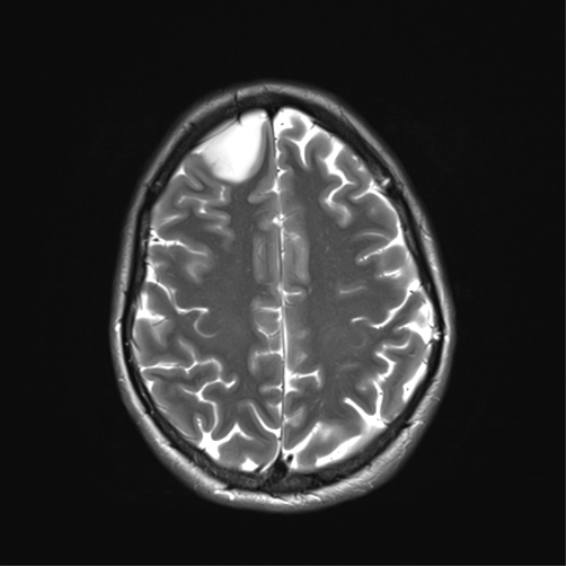 File:Anaplastic astrocytoma IDH mutant (Radiopaedia 50046-55341 Axial T2 29).png