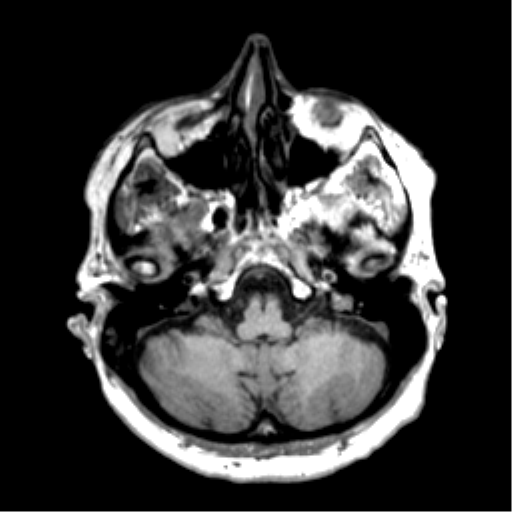 Anaplastic astrocytoma IDH wild-type (pseudoprogression) (Radiopaedia 42209-45277 Axial T1 25).png