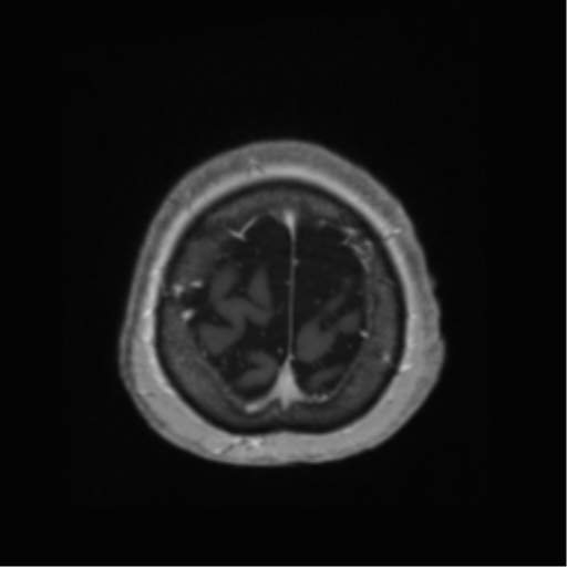 Anaplastic astrocytoma IDH wild-type (pseudoprogression) (Radiopaedia 42209-45278 Axial T1 C+ 139).png
