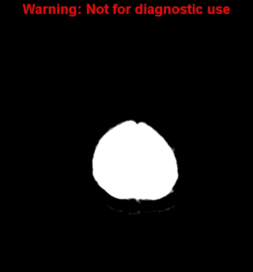File:Anaplastic ganglioglioma (Radiopaedia 44921-48815 Axial non-contrast 29).jpg