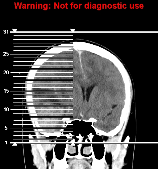 File:Anaplastic ganglioglioma (Radiopaedia 44921-48815 B 1).jpg