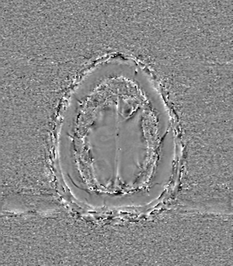 Anaplastic oligodendroglioma (Radiopaedia 83500-98599 Axial SWI - phase 82).png