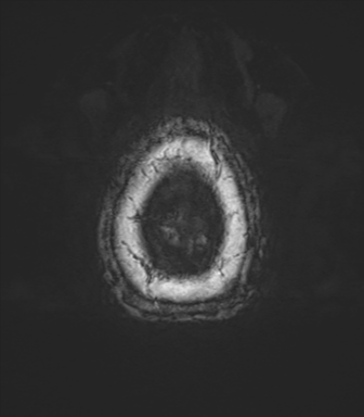 Anaplastic oligodendroglioma (Radiopaedia 83500-98599 L 87).png