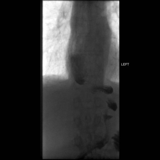 File:Anastomotic stricture post Ivor Lewis esophagectomy (Radiopaedia 47937-52715 C 25).png
