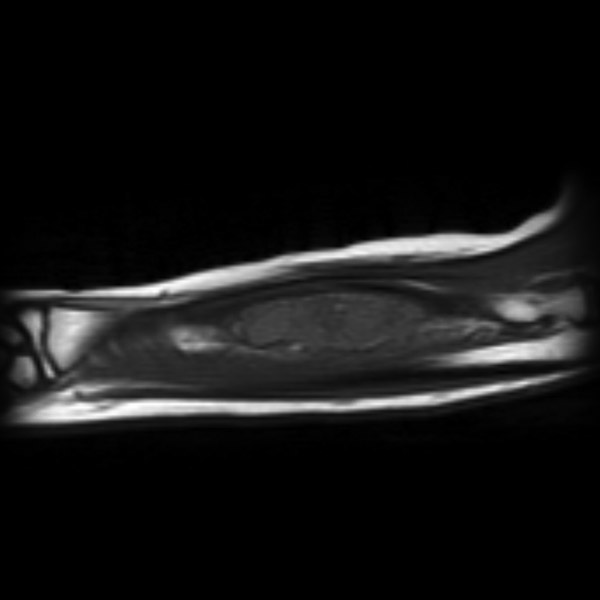 File:Aneurysmal bone cyst - radius (Radiopaedia 5866-7442 Coronal T1 1).jpg