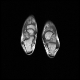 File:Aneurysmal bone cyst - tibia (Radiopaedia 22343-22367 Axial T1 20).jpg