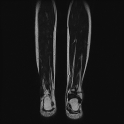 File:Aneurysmal bone cyst - tibia (Radiopaedia 22343-22367 Coronal T2 14).jpg