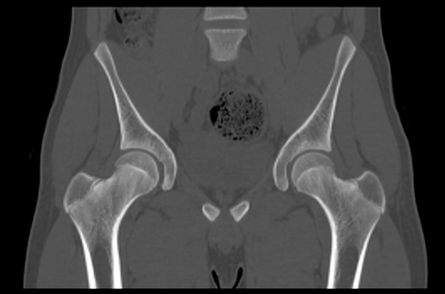 File:Aneurysmal bone cyst of ischium (Radiopaedia 25957-26094 Coronal bone window 17).png