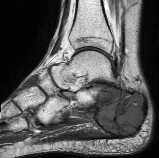File:Aneurysmal bone cyst of the calcaneus (Radiopaedia 60669-68420 Sagittal T1 12).jpg