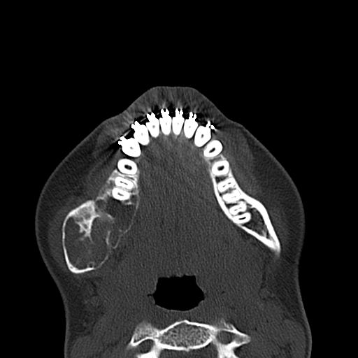 Aneurysmal bone cyst of the mandible (Radiopaedia 43280-46601 Axial bone window 25).jpg