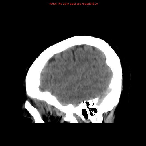 File:Aneurysmal subarachnoid hemorrhage (Radiopaedia 24740-24997 non-contrast 45).jpg