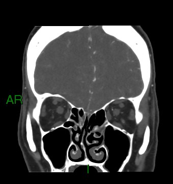 Aneurysmal subarachnoid hemorrhage with intra-axial extension (Radiopaedia 84371-99732 C 77).jpg