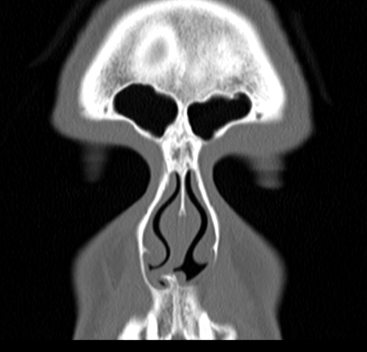 Angular epidermoid cyst (Radiopaedia 46908-51439 Coronal bone window 16).png