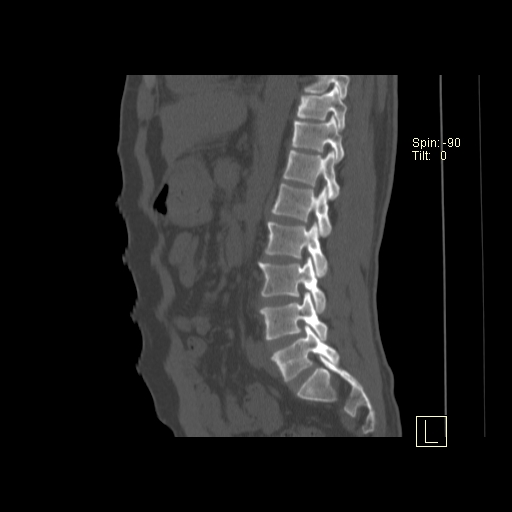 File:Ankylosing spondylitis (Radiopaedia 52728-58645 Sagittal bone window 6).jpg