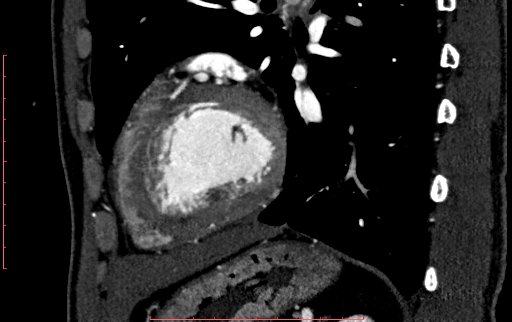 File:Anomalous left coronary artery from the pulmonary artery (ALCAPA) (Radiopaedia 70148-80181 C 185).jpg