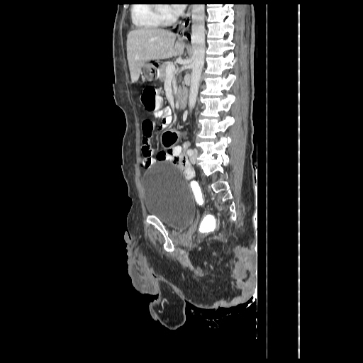 File:Anorectal carcinoma (Radiopaedia 44413-48064 C 60).jpg