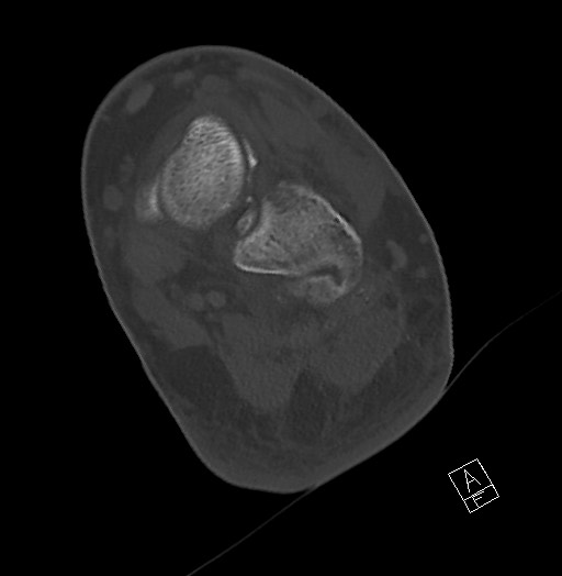Anterior calcaneal process fracture (Radiopaedia 63353-71943 Axial bone window 90).jpg