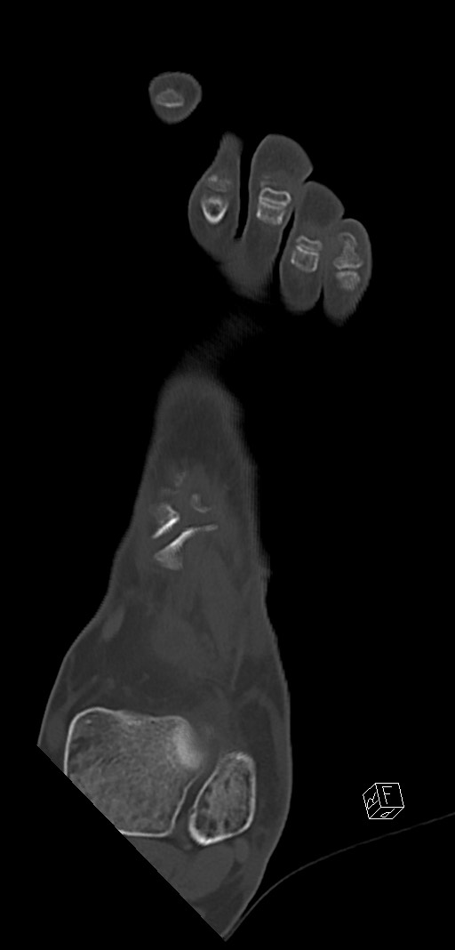 Anterior calcaneal process fracture (Radiopaedia 63353-71943 Coronal bone window 13).jpg