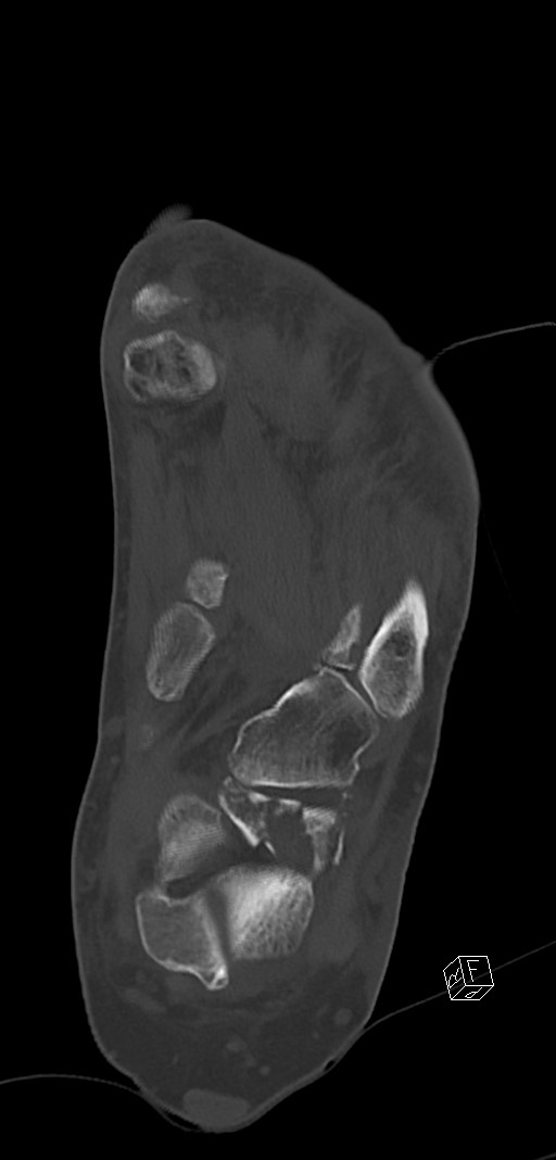 Anterior calcaneal process fracture (Radiopaedia 63353-71943 Coronal bone window 29).jpg