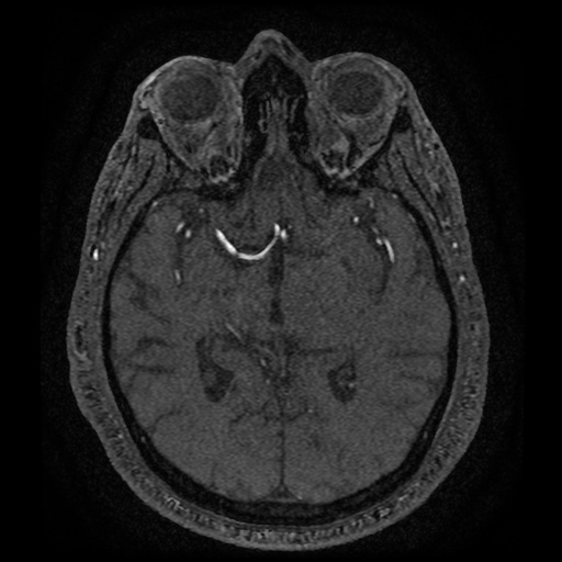 Anterior cerebral artery infarction (Radiopaedia 46794-51323 Axial MRA 94).jpg