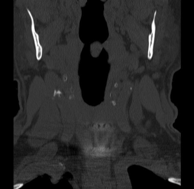 Anterior cervical postdiscectomy arthrodesis (Radiopaedia 32678-33646 Coronal bone window 6).jpg