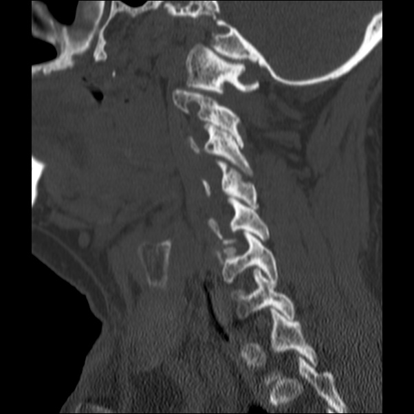 Anterior cervical postdiscectomy arthrodesis (Radiopaedia 32678-33646 Sagittal bone window 55).jpg