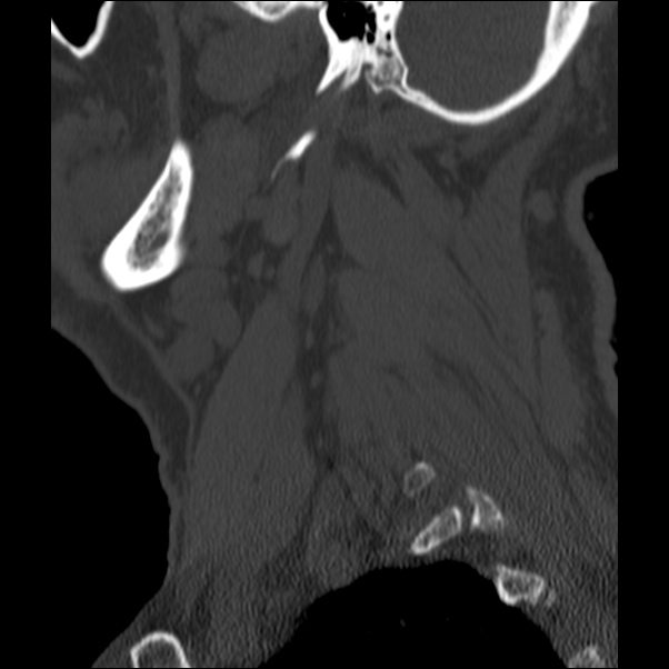 Anterior cervical postdiscectomy arthrodesis (Radiopaedia 32678-33646 Sagittal bone window 73).jpg