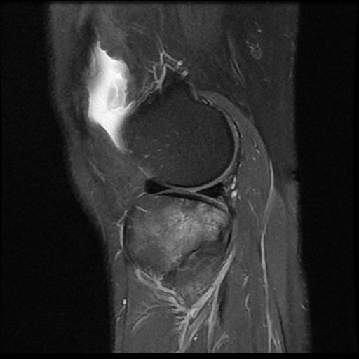 File:Anterior cruciate ligament avulsion fracture (Radiopaedia 58939-66193 Sagittal PD fat sat 6).jpg