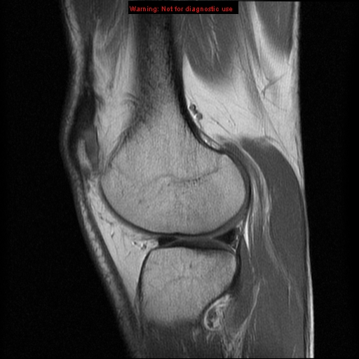 File:Anterior cruciate ligament injury - partial thickness tear (Radiopaedia 12176-12515 Sagittal PD 14).jpg
