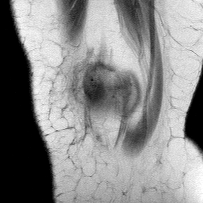 Anterior cruciate ligament mucoid degeneration (Radiopaedia 60853-68633 Sagittal T1 34).jpg