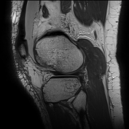 Anterior cruciate ligament rupture with Segond fracture (Radiopaedia 69043-78806 Sagittal PD 142).jpg