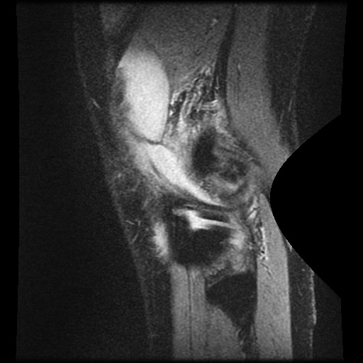 Anterior cruciate ligament tear (Radiopaedia 61500-69462 F 83).jpg