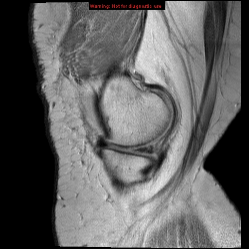 File:Anterior cruciate ligament tear - complete (Radiopaedia 12175-12514 Sagittal PD 17).jpg